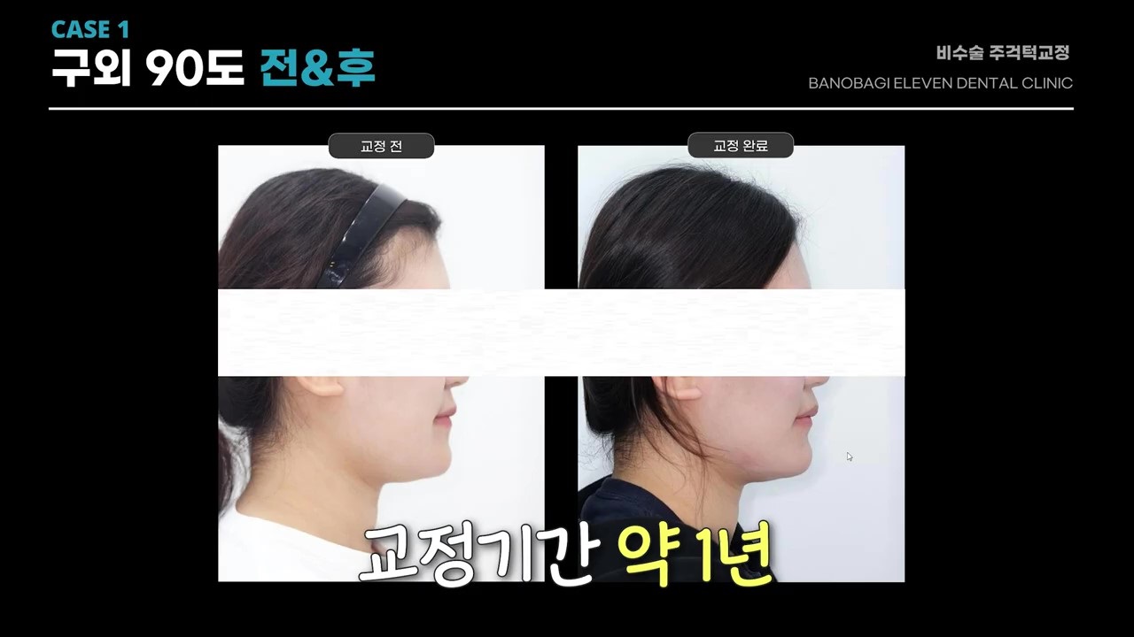 영상 캡처 cap05 - CASE 1 측면 90도 전후 비교(교정기간 약 1년) 이미지 삽입
