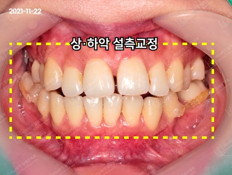 상하악 설측교정 장치를 부착한 정면 모습