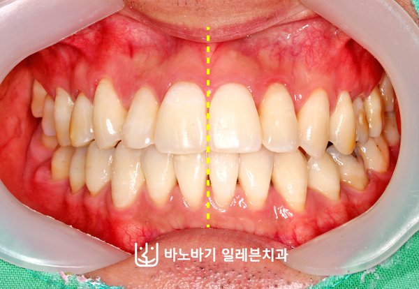 교정 후 정면 교합, 가지런해진 앞니와 일치한 중심선