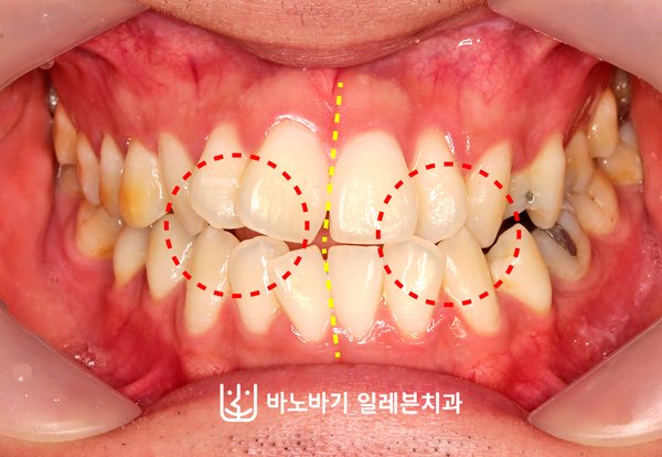 교정 전 정면 교합, 겹친 앞니와 어긋난 중심선