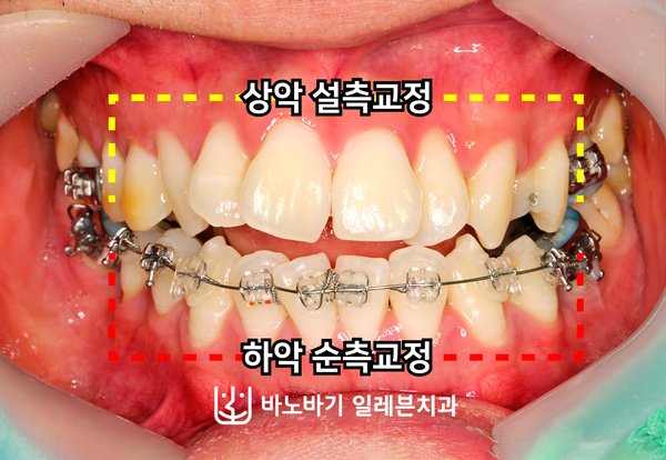 치료 중 정면, 상악 설측교정과 하악 순측교정