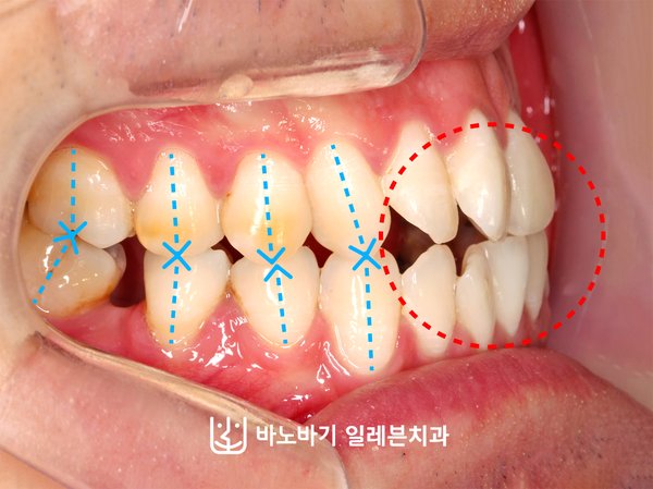 교정 전 측면 교합, 앞니와 어금니의 절단교합