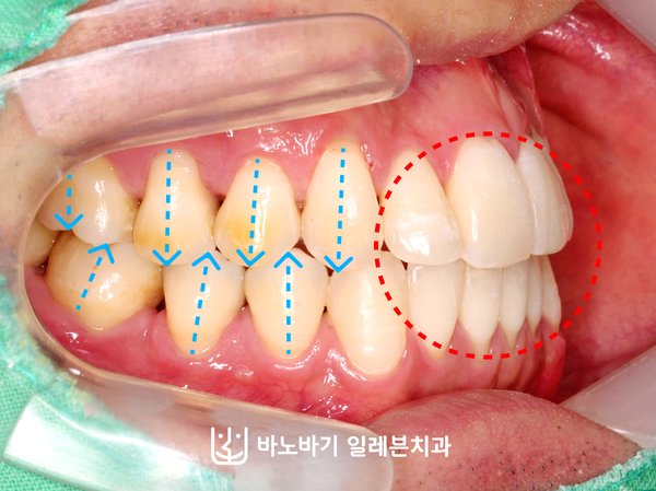 교정 후 측면 교합, 긴밀하게 맞물린 앞니와 어금니