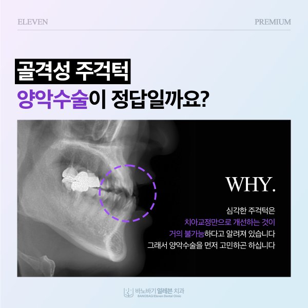 골격성 주걱턱, 양악수술이 정답일까요