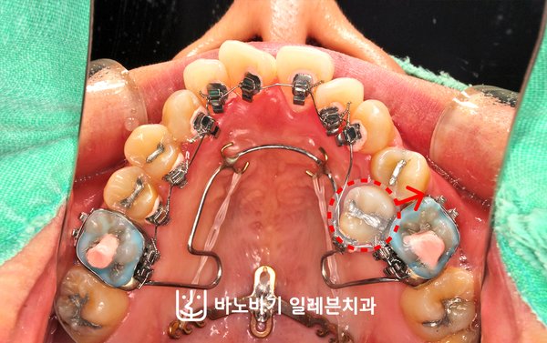 치료 중 상악 교합면, 왼쪽 소구치 위치 재조정