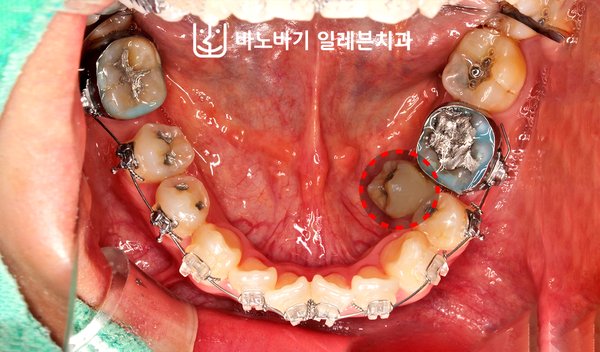 치료 중 하악 교합면, 안쪽으로 들어와 있던 소구치