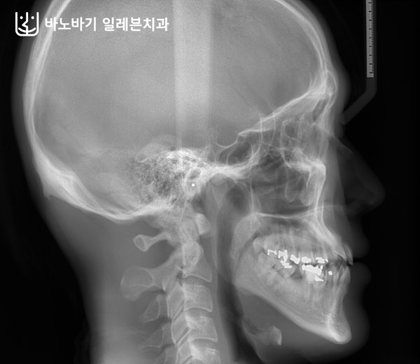 교정 전 측면 두부방사선 사진