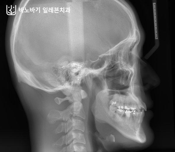 교정 후 측면 두부방사선 사진