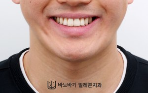 긴 턱 교정 후 웃는 얼굴