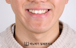 긴 턱 교정 전 웃는 얼굴