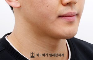 긴 턱 교정 후 45도 얼굴