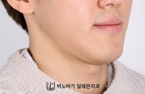 긴 턱 교정 전 45도 얼굴