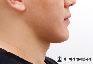 긴 턱 교정 후 옆모습