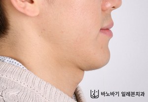 긴 턱 교정 전 옆모습