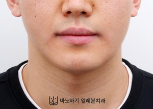 긴 턱 교정 후 정면 얼굴