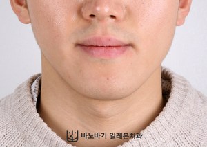 긴 턱 교정 전 정면 얼굴