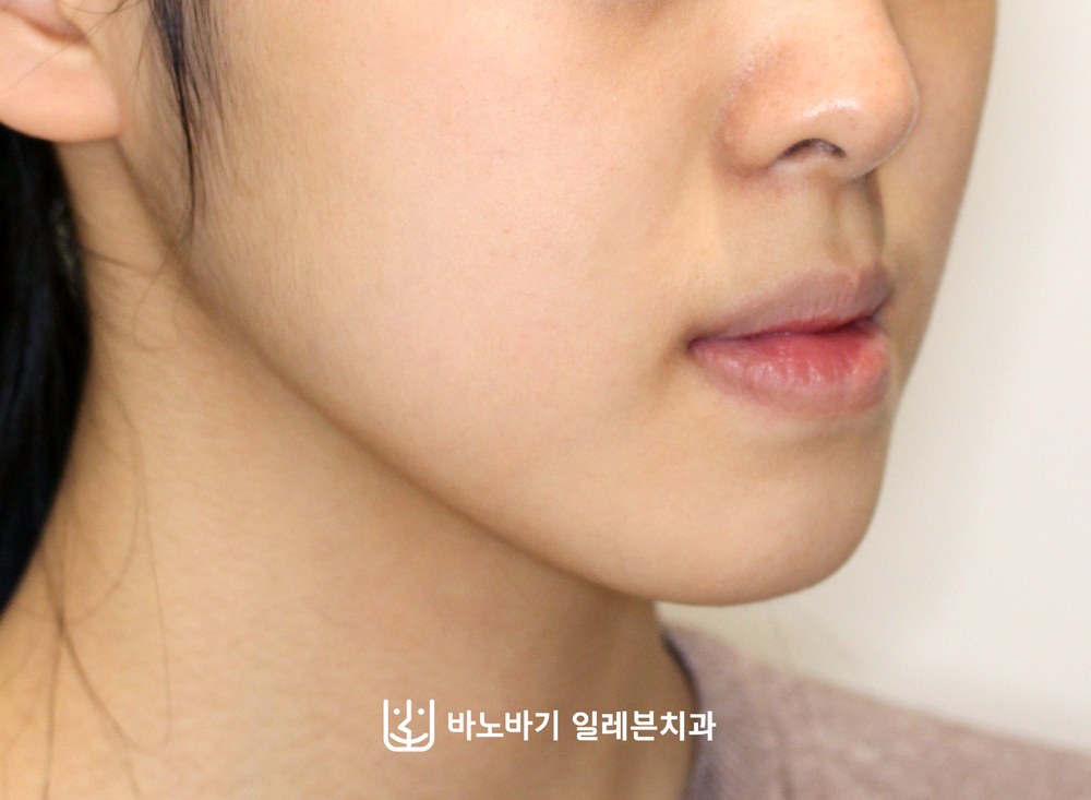 청소년 주걱턱 교정 전 옆모습, 앞으로 나온 아래턱과 아랫입술