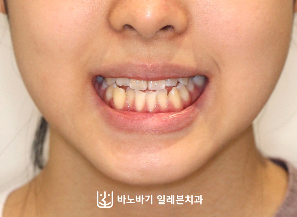 청소년 주걱턱 교정 전 정면 미소