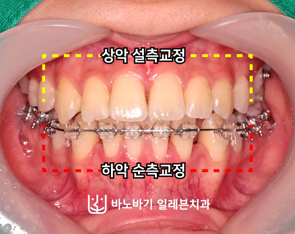 치료 중 정면, 상악 설측교정과 하악 순측교정