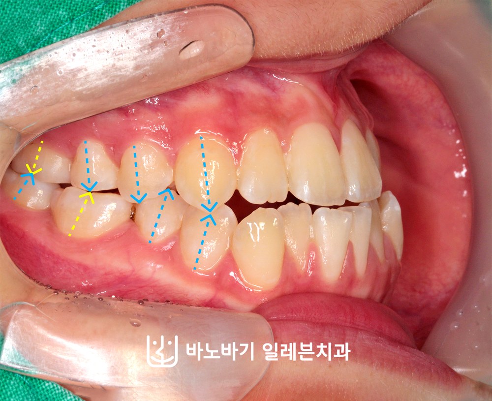 교정 전 우측 교합, 제1대구치 기준 3급 부정교합