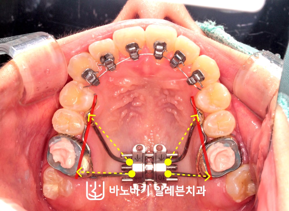 상악 악궁확장장치와 설측교정 장치