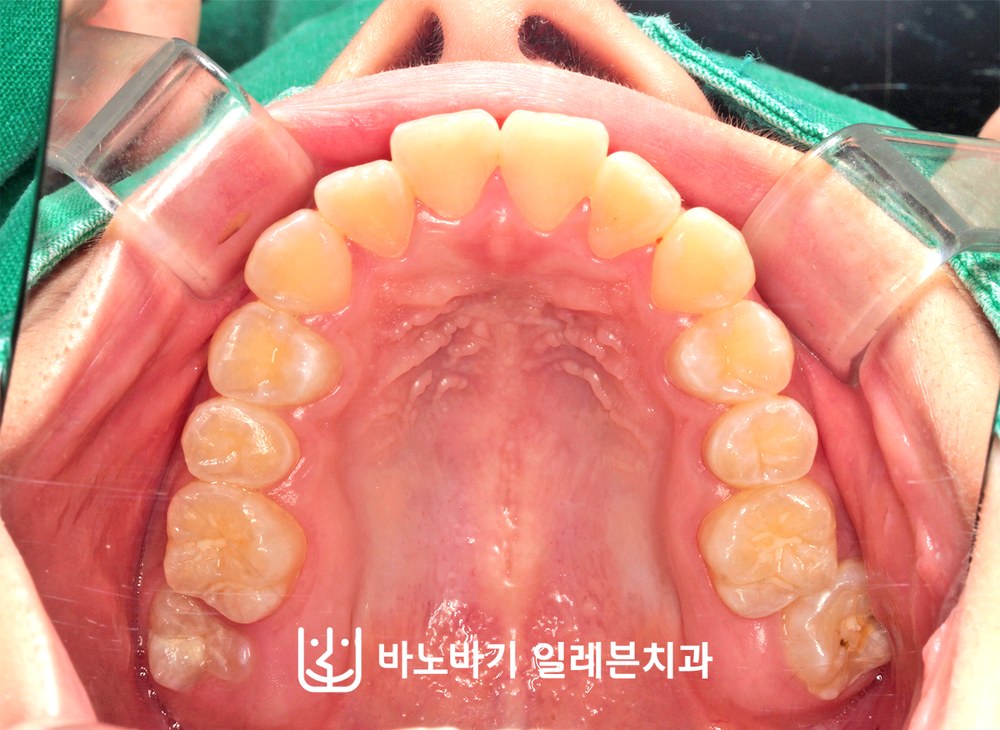 교정 전 상악 교합면