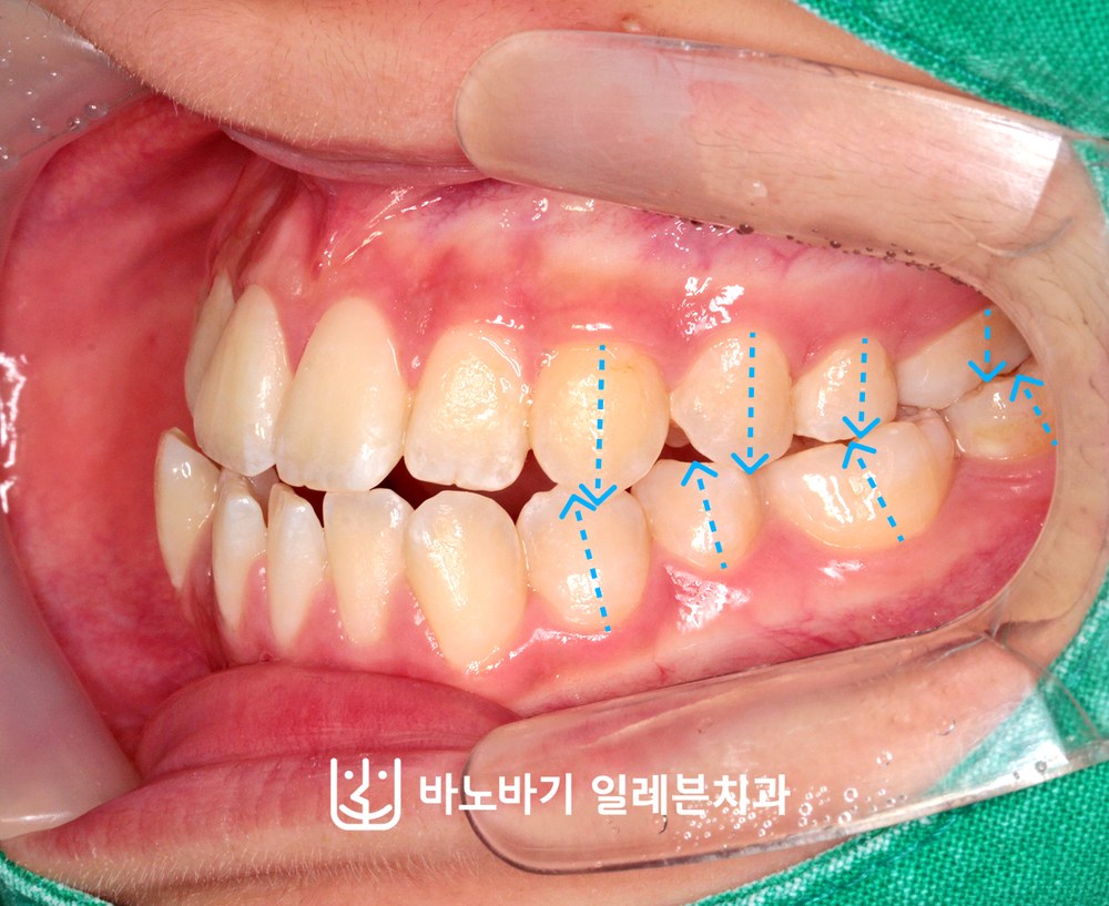 교정 전 좌측 교합