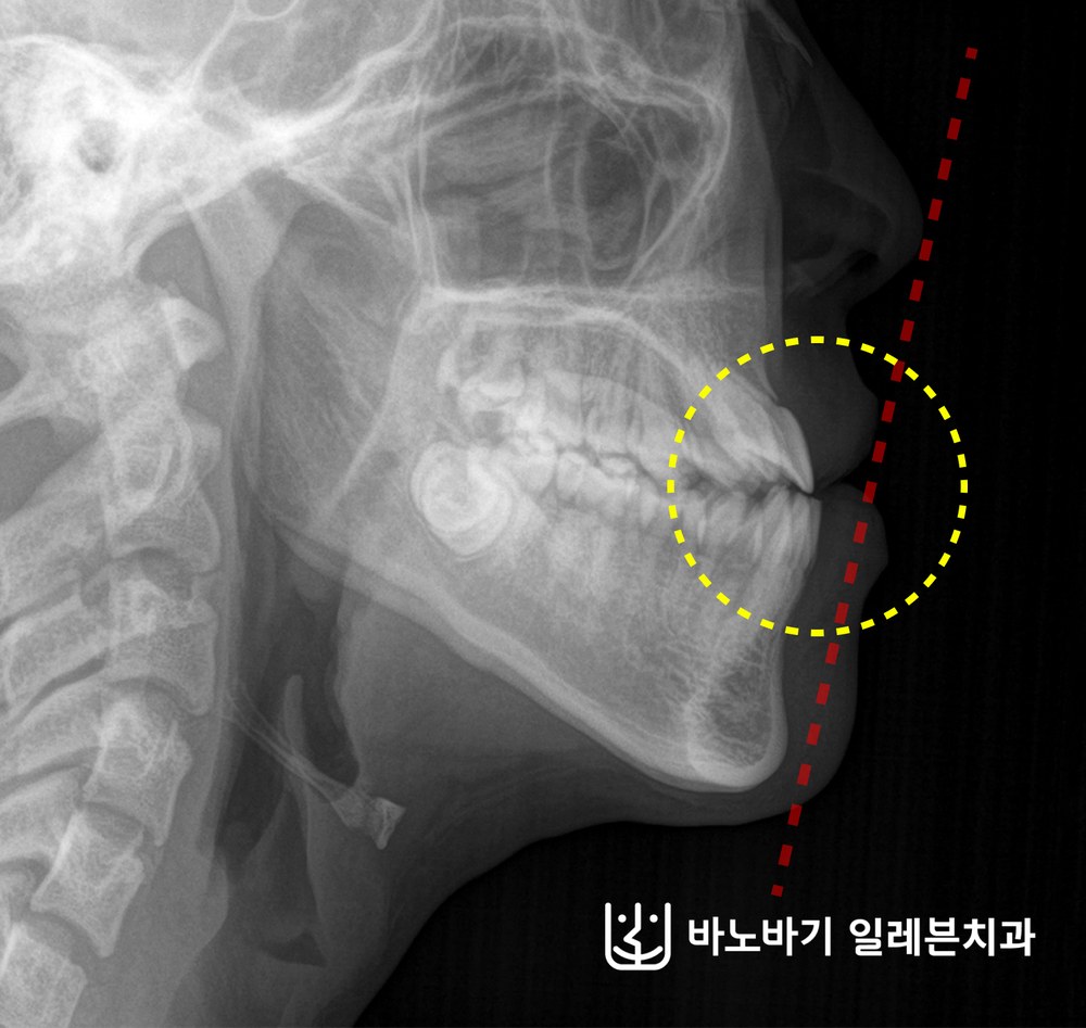 교정 전 측면 두부방사선 사진, 하악이 앞쪽에 위치한 3급 부정교합