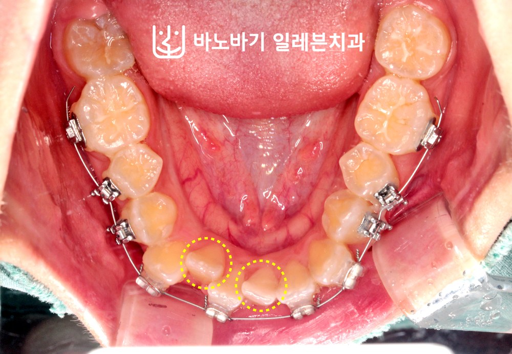 치료 중 하악 교합면, 순측교정으로 배열 중인 하악 전치부