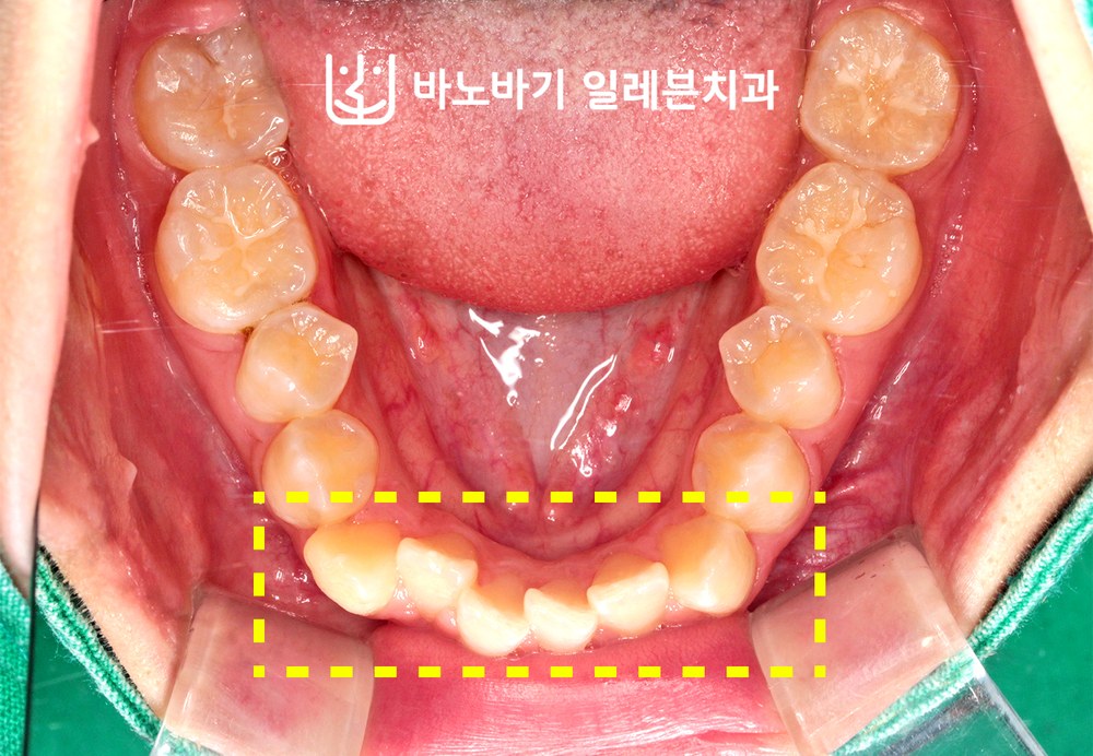 교정 전 하악 교합면, 앞쪽으로 갈수록 좁아진 악궁과 치아밀집