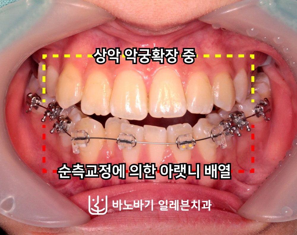 치료 중 정면, 상악 악궁확장과 하악 순측교정