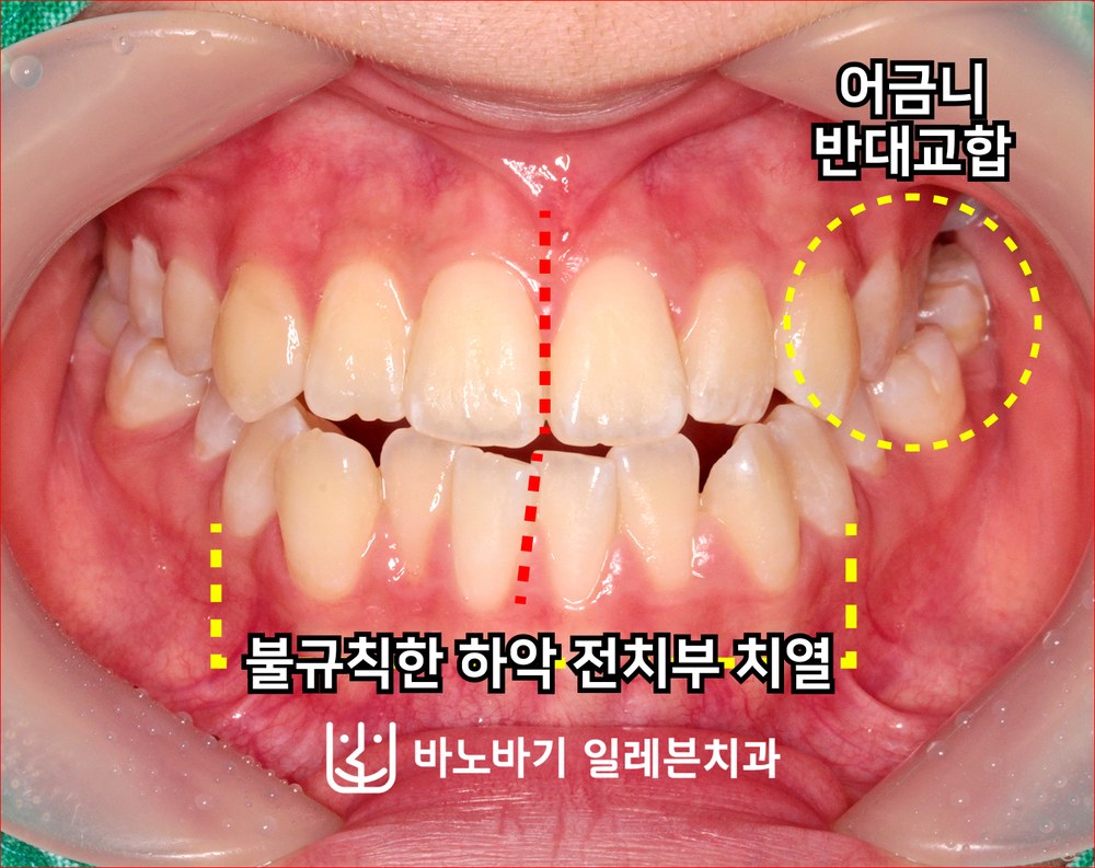 교정 전 정면 교합, 불규칙한 하악 전치부와 왼쪽 어금니 반대교합