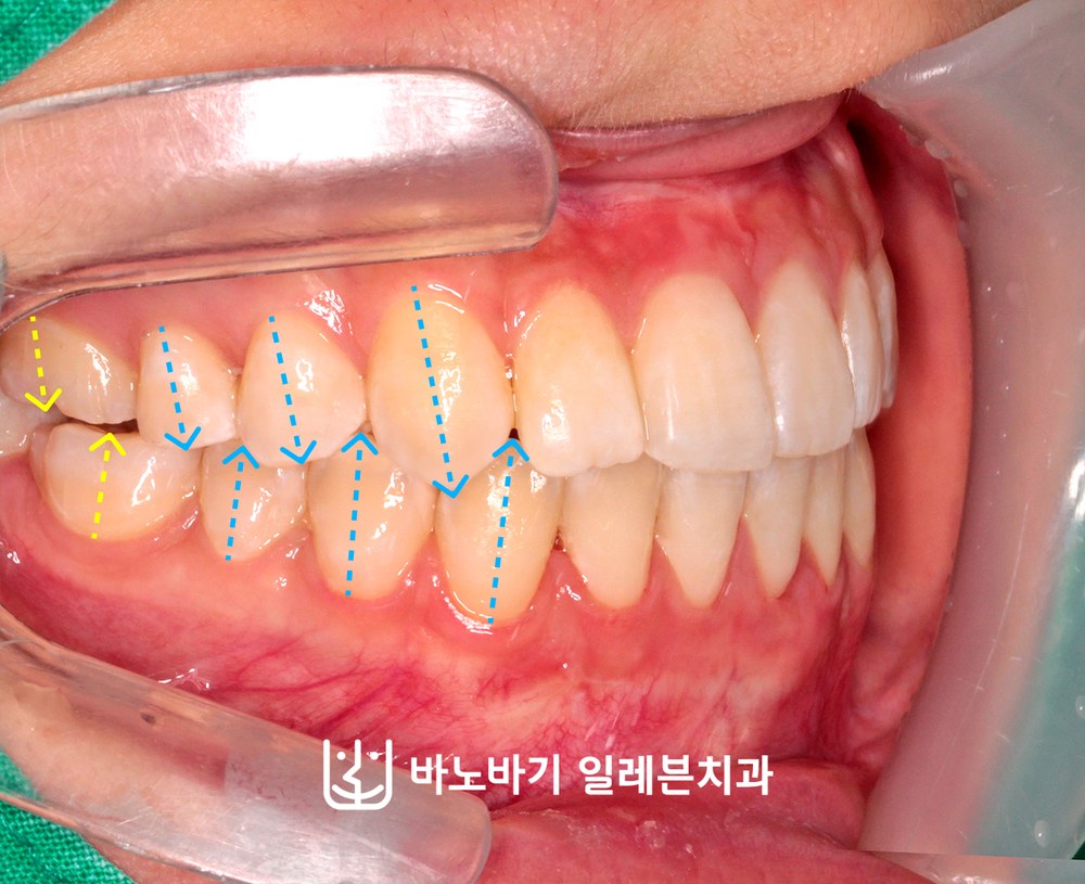 교정 후 우측 교합, 긴밀하게 맞물린 어금니