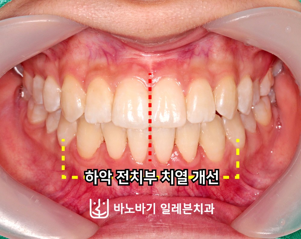 교정 후 정면 교합, 고르게 배열된 하악 전치부