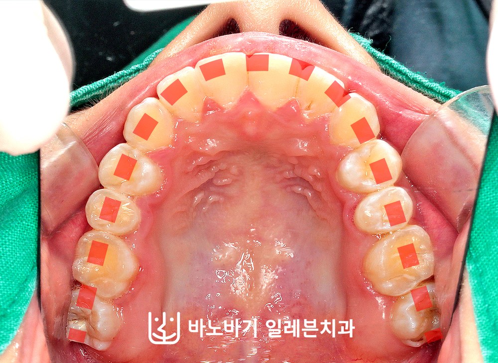 교정 후 상악 교합면