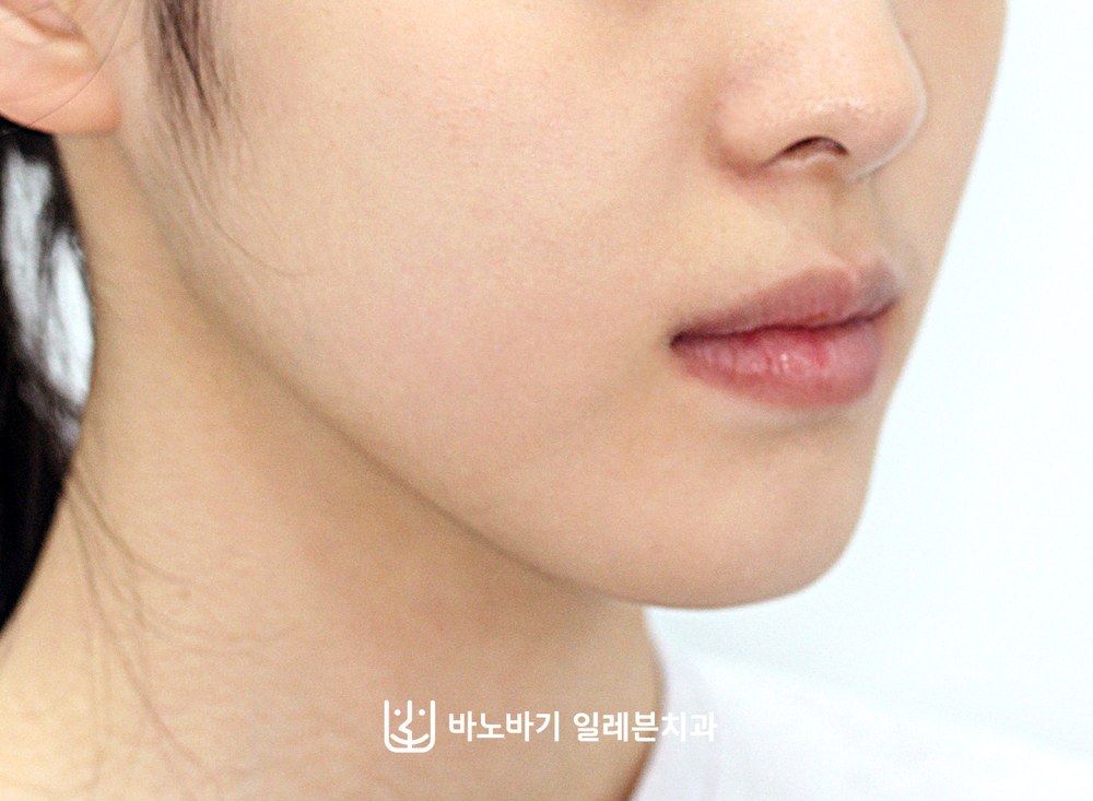 청소년 주걱턱 교정 후 측면 얼굴