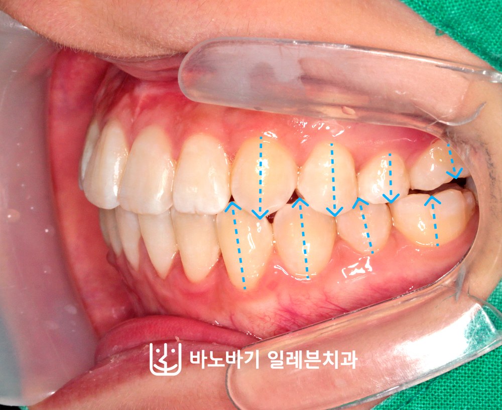 교정 후 좌측 교합