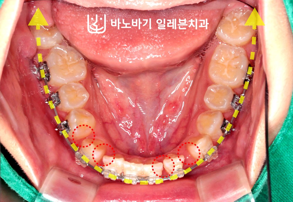 치료 중 하악 교합면, 하악 치열의 후방이동
