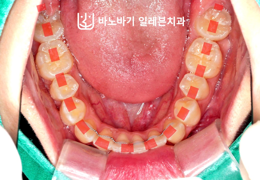 교정 후 하악 교합면, 완만한 아치 형태로 정리된 치열
