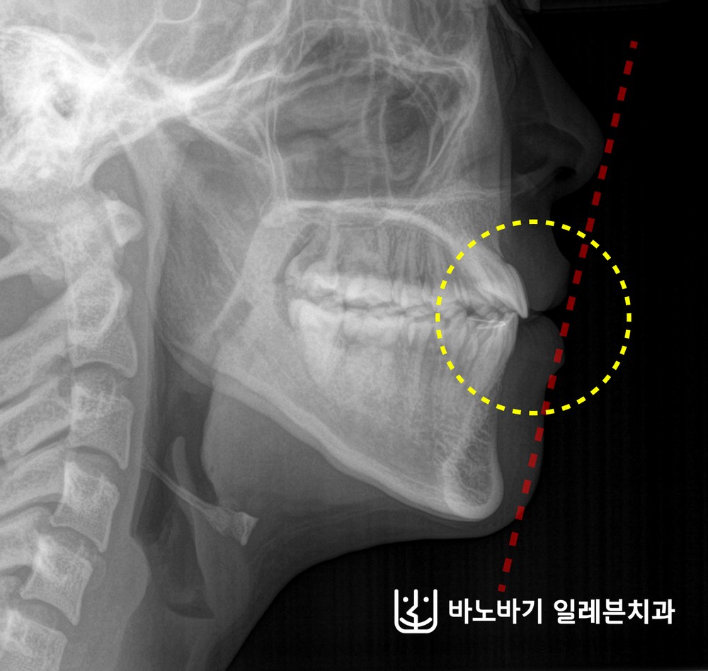 교정 후 측면 두부방사선 사진