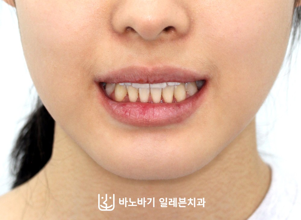 청소년 주걱턱 교정 후 정면 미소
