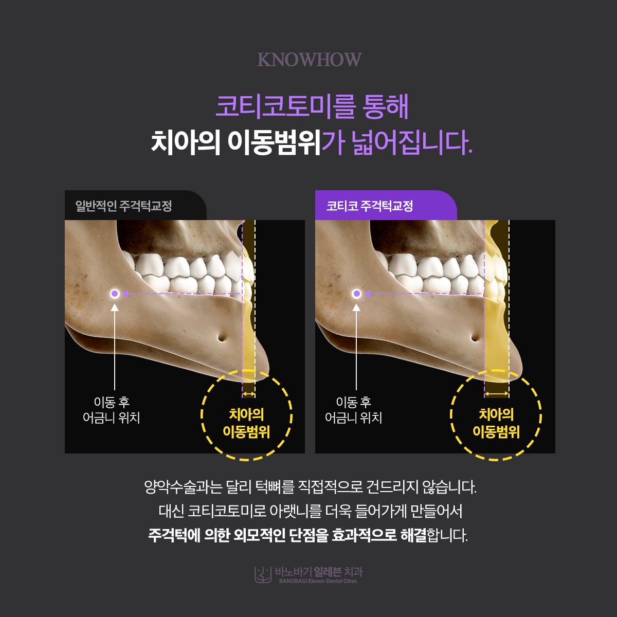 코티코토미로 넓어지는 치아의 이동범위, 일반적인 주걱턱교정과 코티코 주걱턱교정 비교