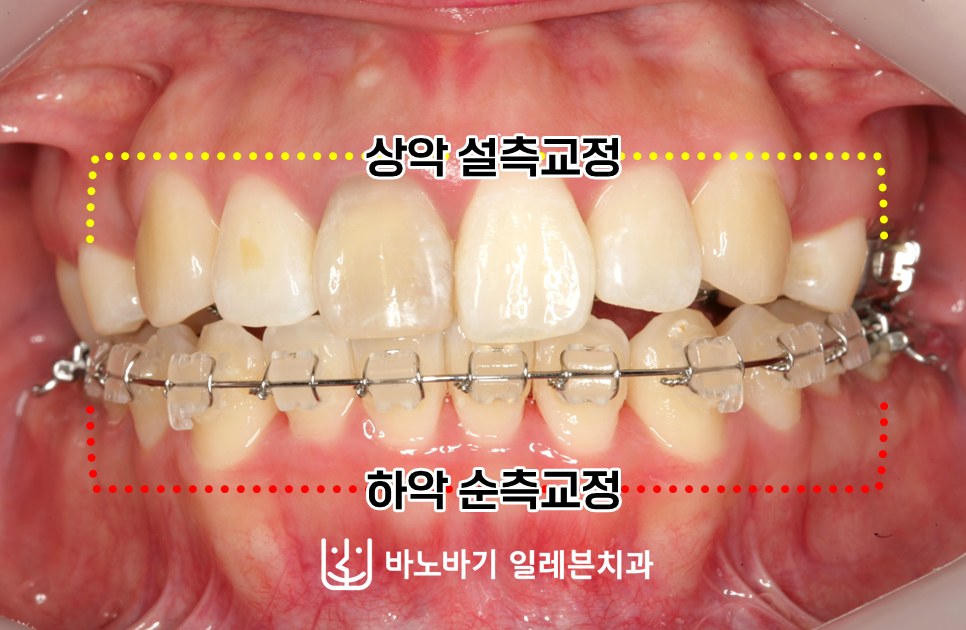 상악 설측교정과 하악 순측교정을 함께 적용한 콤비교정