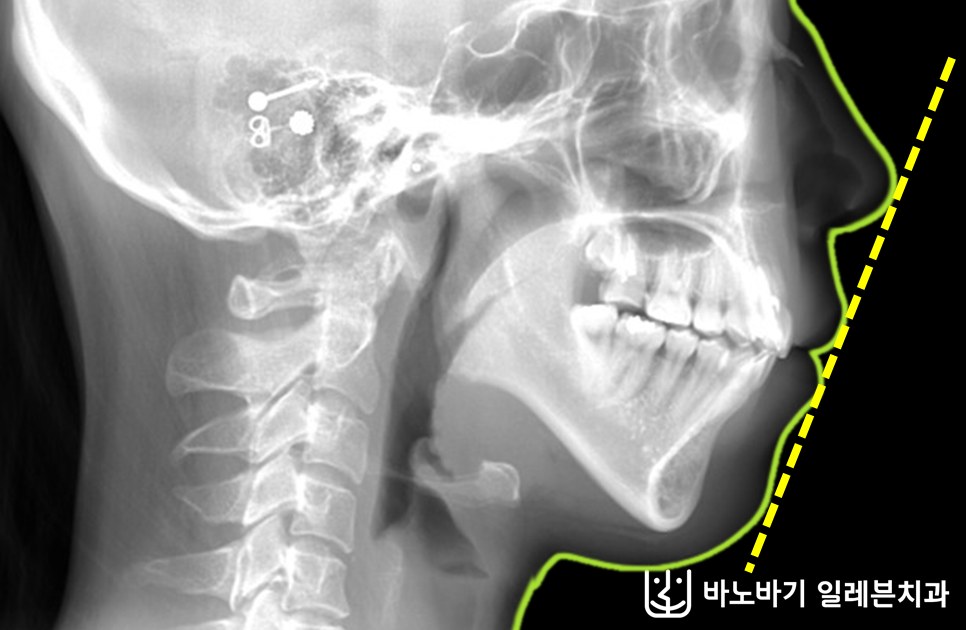 무턱 교정 후 측면 두부방사선 사진, 자연스럽게 다물어진 입술