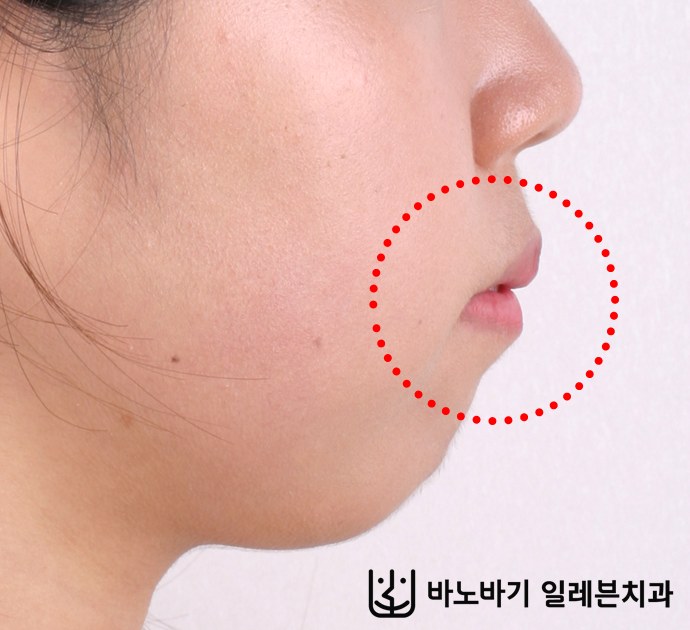 무턱 교정 전 옆모습