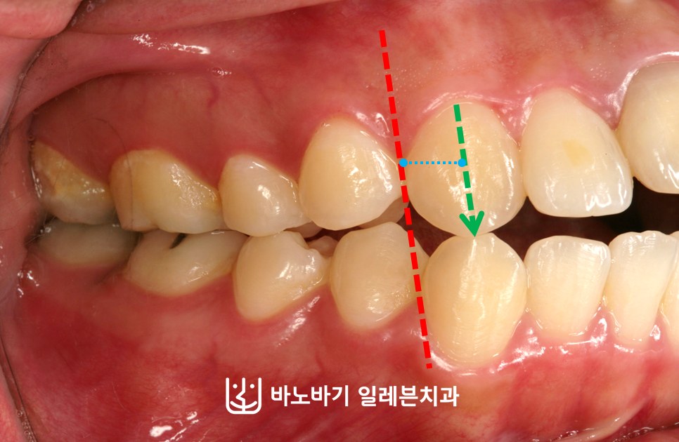 무턱 교정 전 우측 교합, 조정이 필요한 상하 치아의 맞물림