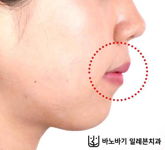무턱 교정 후 옆모습