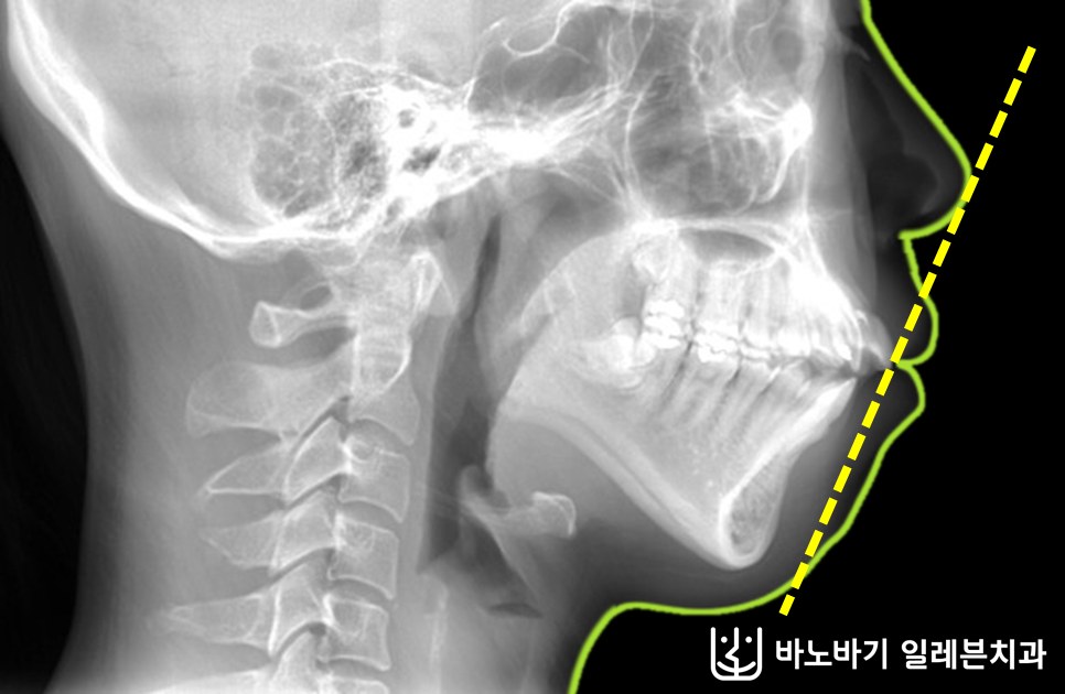무턱 교정 전 측면 두부방사선 사진, 상악보다 뒤에 위치한 하악과 돌출된 입매