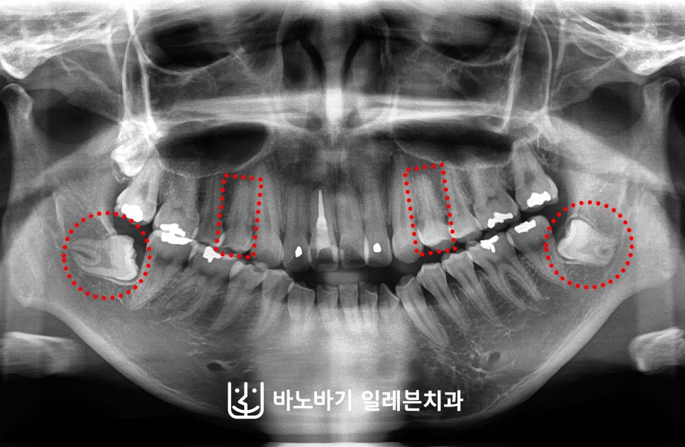 무턱 교정 발치 계획, 상악 제1소구치와 하악 사랑니 표시