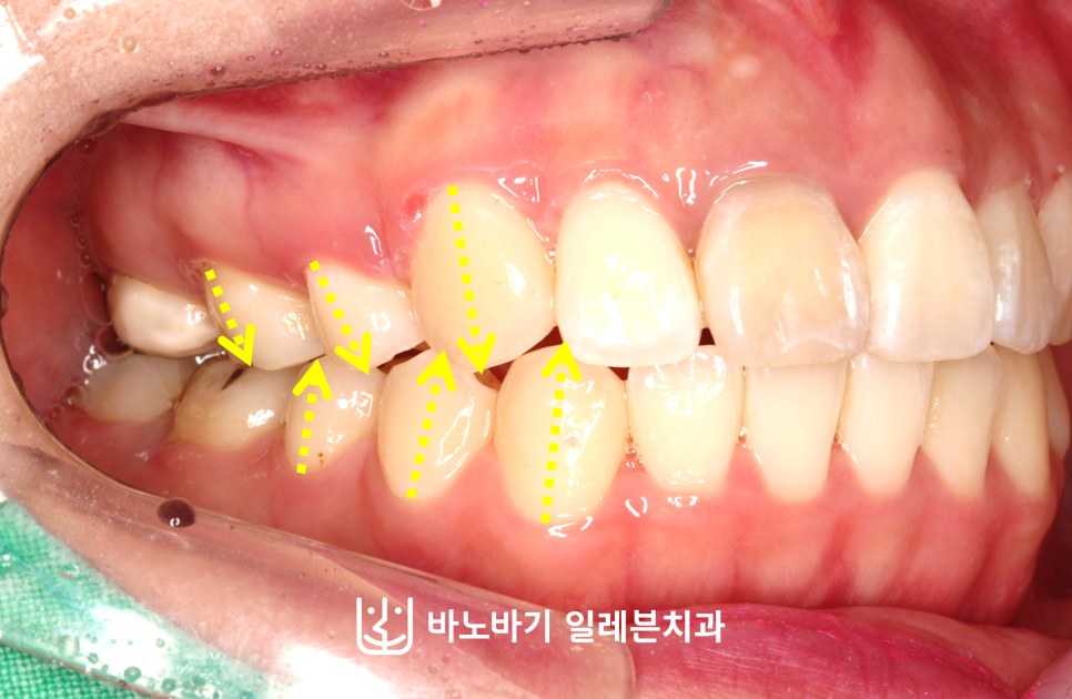 무턱 교정 후 우측 교합, 긴밀하게 맞물린 어금니